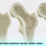 Osteoporosis Bisa Dicegah Sejak Anak-anak