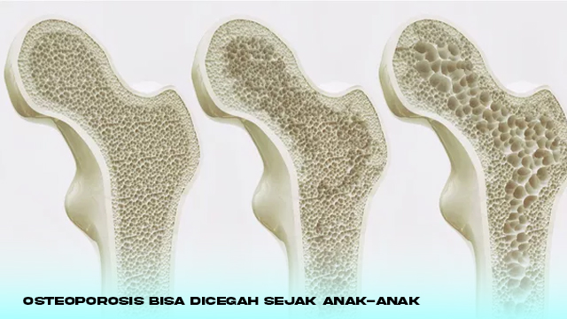 Osteoporosis Bisa Dicegah Sejak Anak-anak